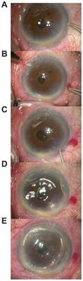 A technique to treat Descemet’s membrane detachment following cataract surgery